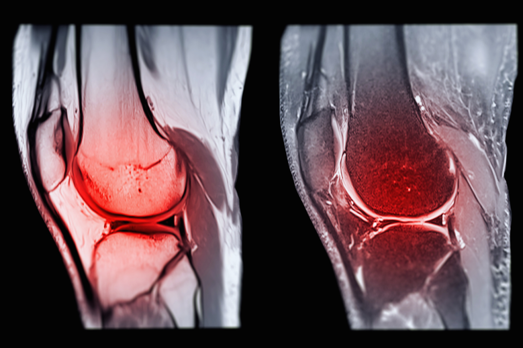 Knee Arthroscopic Ligament Surgery