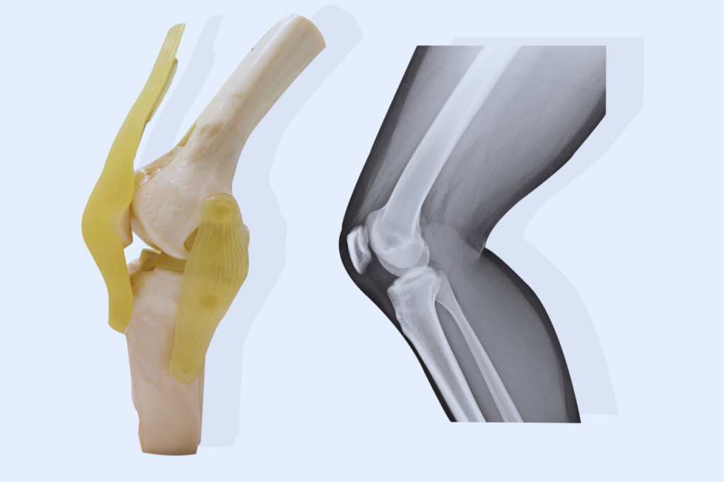 Total Knee Replacement Surgery