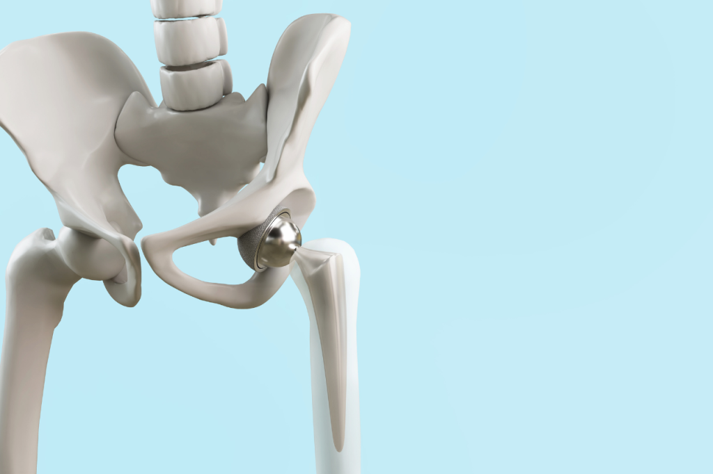 Total Hip Replacement Surgery