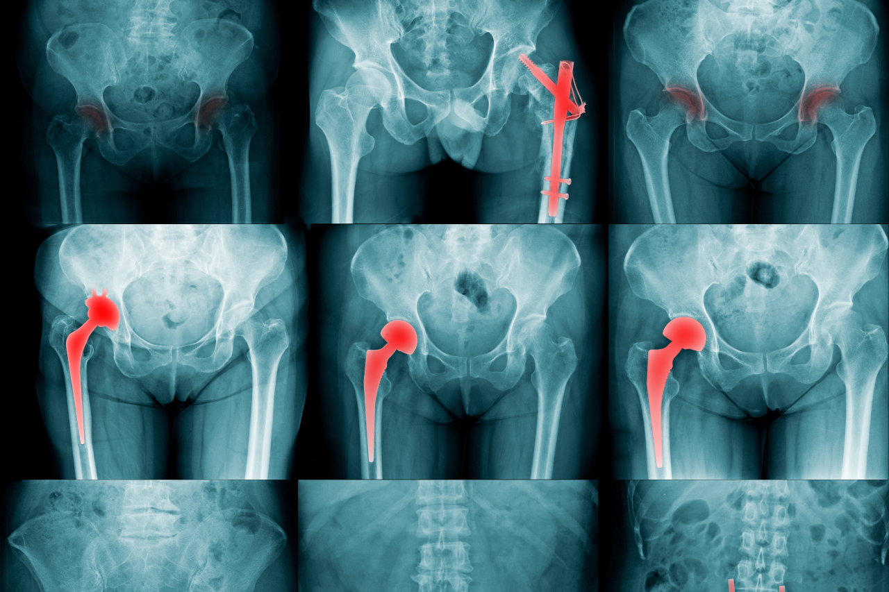 Total Hip Replacement Surgery