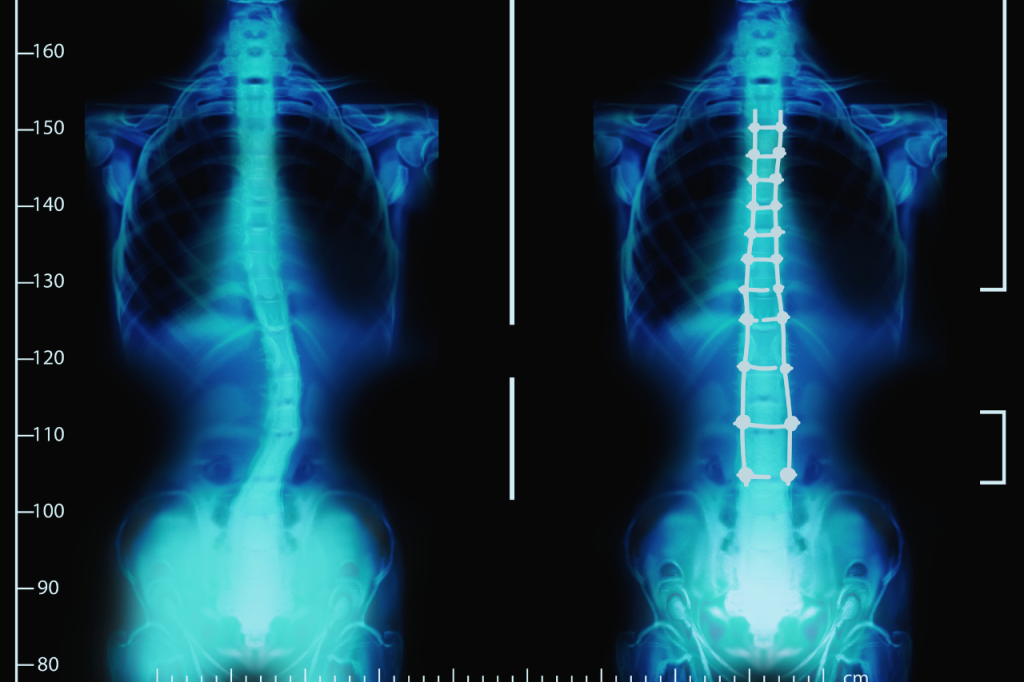 Deformity Corrections