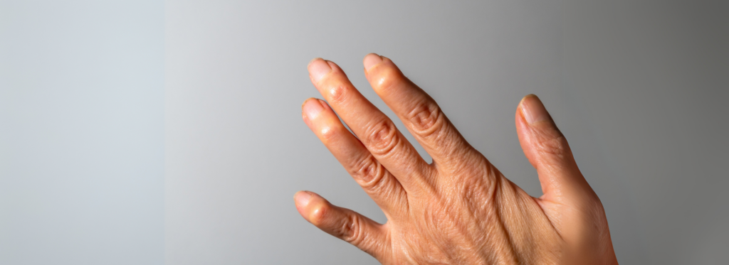 Rheumatoid Arthritis