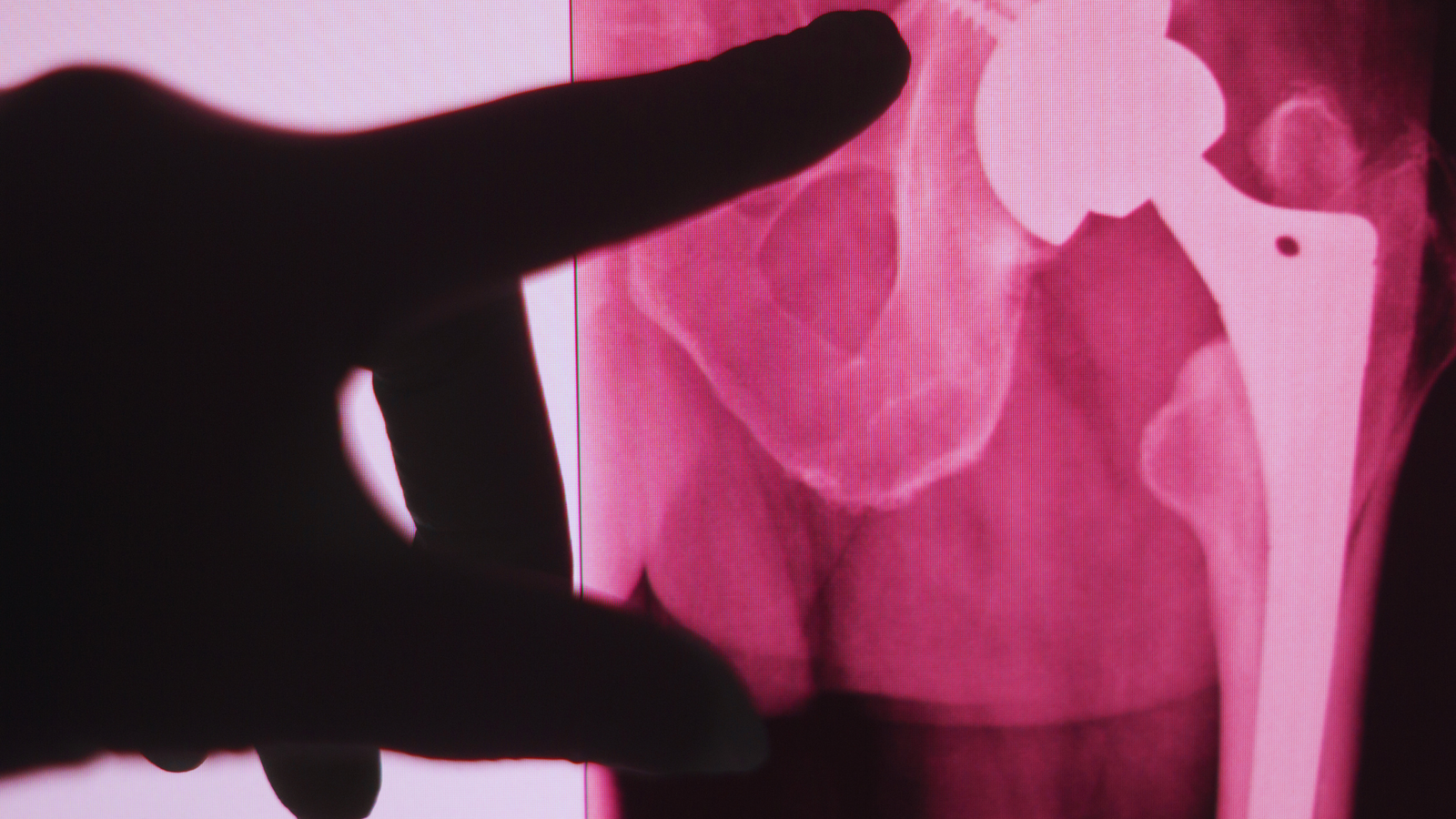 Joint Replacement